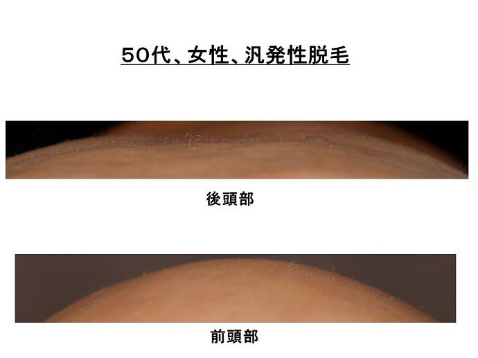 円形脱毛症　病院